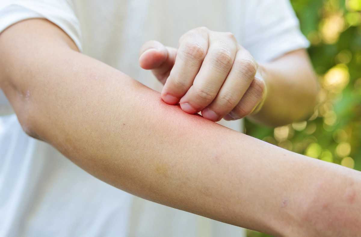 Аллергия на укус комара у взрослых