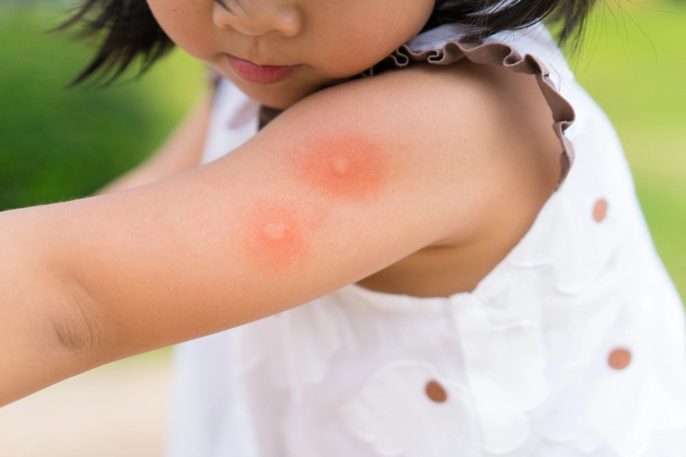 лучшее средство от укусов насекомых для детей